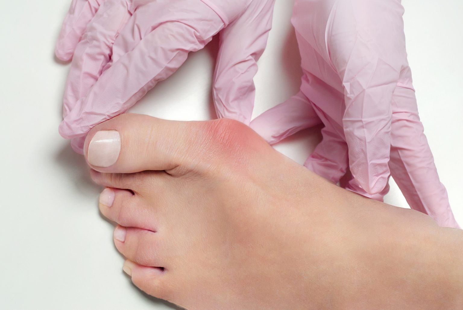 when-to-worry-about-bunions-bunion-treatment-beverly-hills