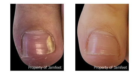 toenail fungus before and after