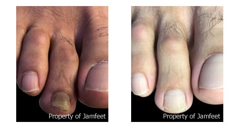 A photograph of a foot with a fungal infection of the toenails