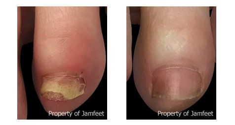 How to Remove an Ingrown Toenail: North Star Foot & Ankle Associates:  Podiatry