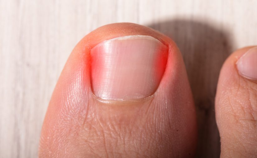 Remedies for An Ingrown Toenail