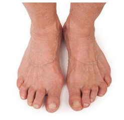 Rheumatoid Arthritis in Feet