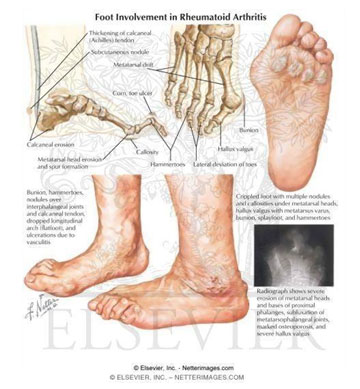 Infographic on Foot Involvement in Rheumatoid Arthritis picture