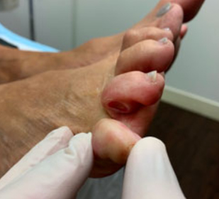 Diabetic foot before picture