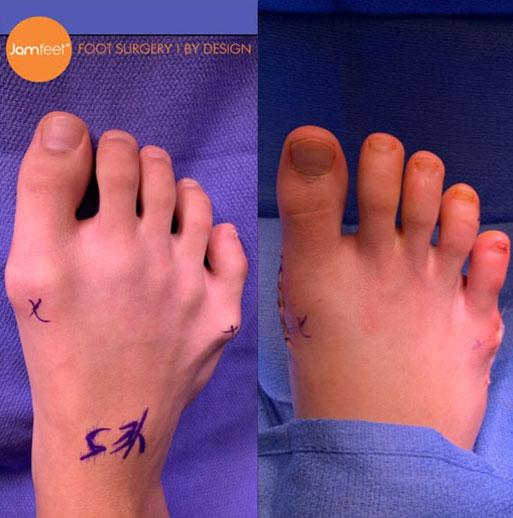 Bunion foot before and after image