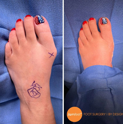 Bunion foot before and after image