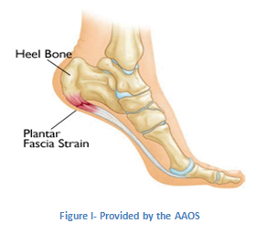 Plantar fascia strain vector illustration