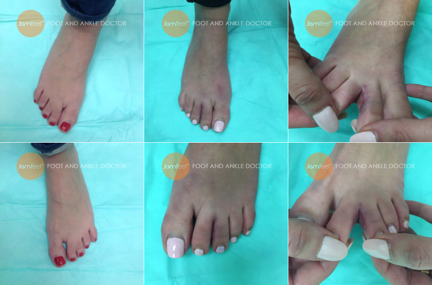 webbed toe separation surgery