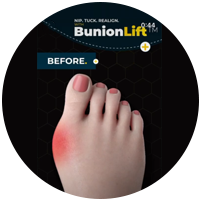 Bunion Lift