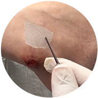 A person carefully holds a needle near a wound on their leg, preparing for a medical procedure.